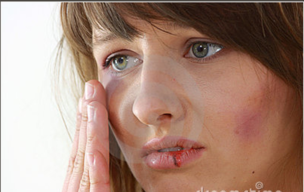 bruised girl